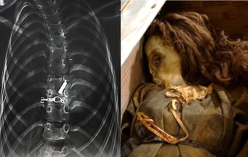 Vista anteroposterior del dorso de la momia 6, donde se observan objetos de metal, entre ellos un broche.