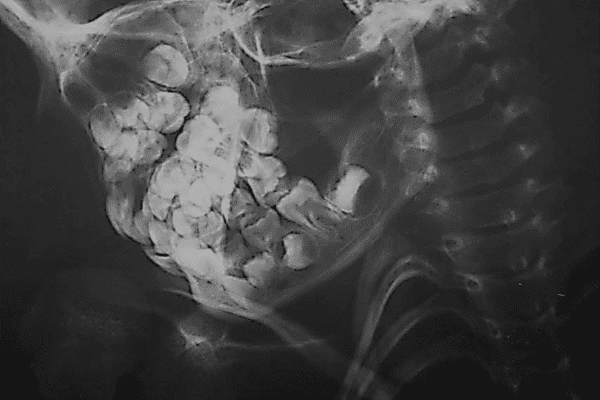 Radiografía dental de la momia 6 en vista lateral derecha (edad dental estimada de 7,5 años)