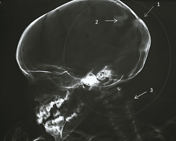 Traumatismo en el área del occipital en momia infantil 8