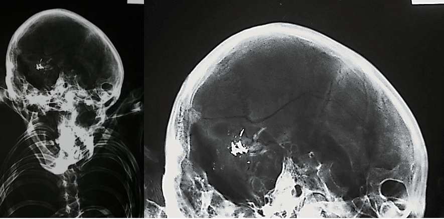 Imagen del cráneo de momia 9 y traumatismo en occipital