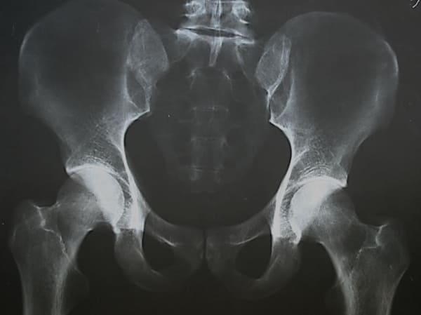 Presencia de osteofitos en articulación sacroilíaca y disminución del espacio articular en el acetábulo femoral.